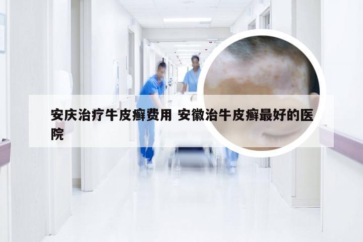 安庆治疗牛皮癣费用 安徽治牛皮癣最好的医院