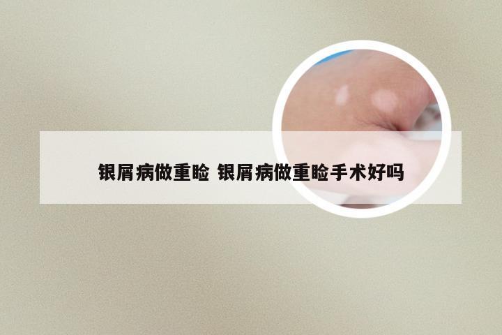 银屑病做重睑 银屑病做重睑手术好吗