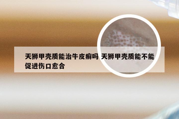 天狮甲壳质能治牛皮癣吗 天狮甲壳质能不能促进伤口愈合