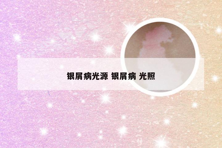 银屑病光源 银屑病 光照
