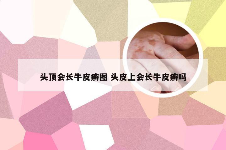 头顶会长牛皮癣图 头皮上会长牛皮癣吗