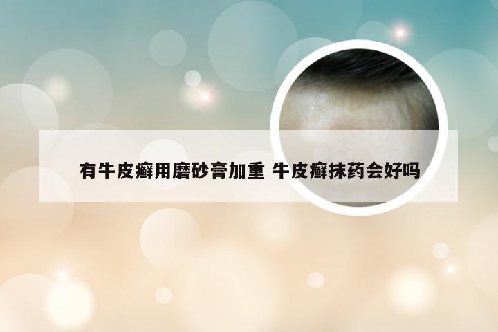 有牛皮癣用磨砂膏加重 牛皮癣抹药会好吗