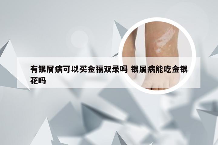 有银屑病可以买金福双录吗 银屑病能吃金银花吗