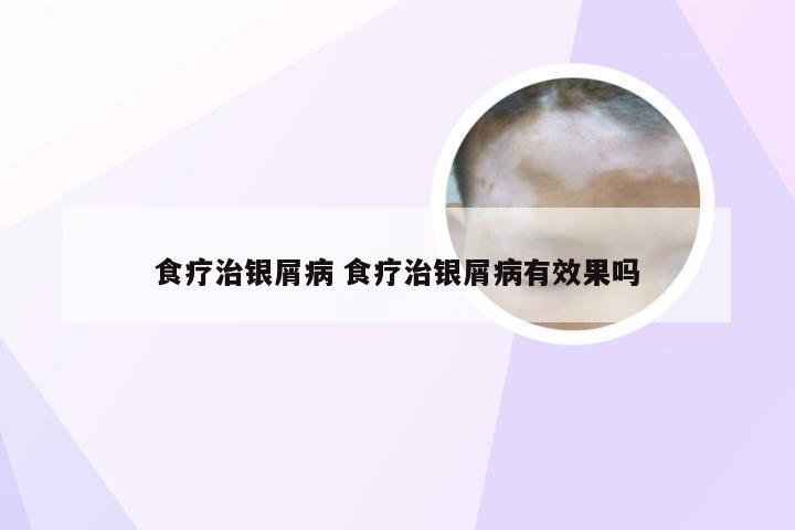 食疗治银屑病 食疗治银屑病有效果吗