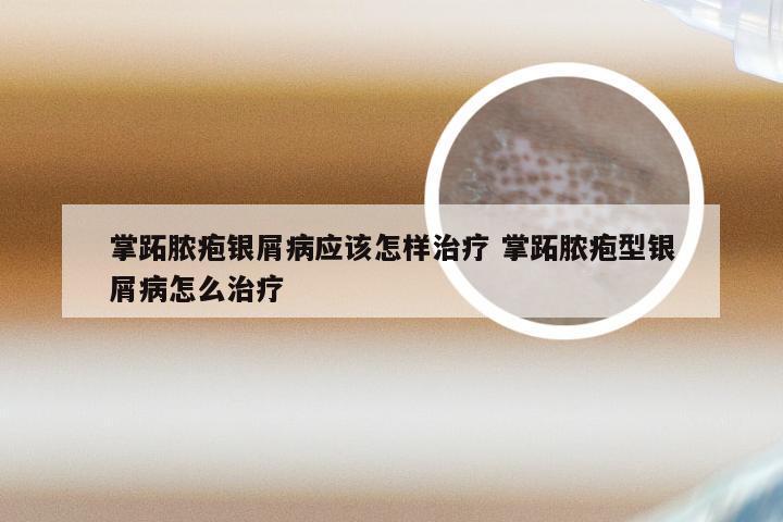 掌跖脓疱银屑病应该怎样治疗 掌跖脓疱型银屑病怎么治疗
