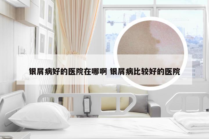 银屑病好的医院在哪啊 银屑病比较好的医院