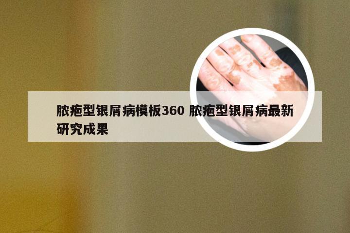 脓疱型银屑病模板360 脓疱型银屑病最新研究成果